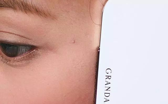 暗疮的最佳解决方法,暗疮怎么回事