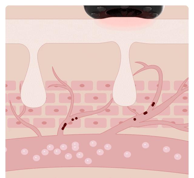 电动刮痧拔罐仪能随便拔罐吗,电动刮痧拔罐仪排毒