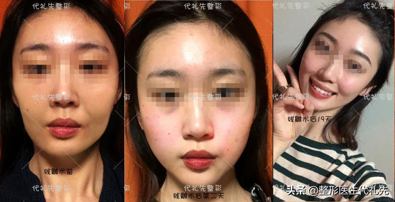 面部埋线提升能维持多久,面部埋线提升