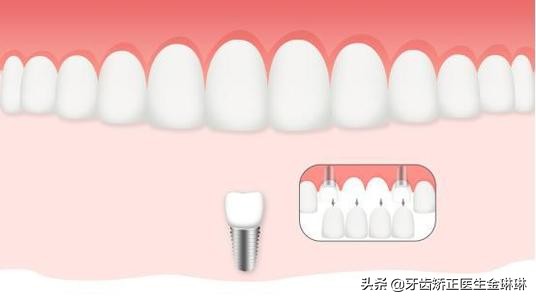 淄博市种植牙哪里最好,淄博正规种植牙推荐