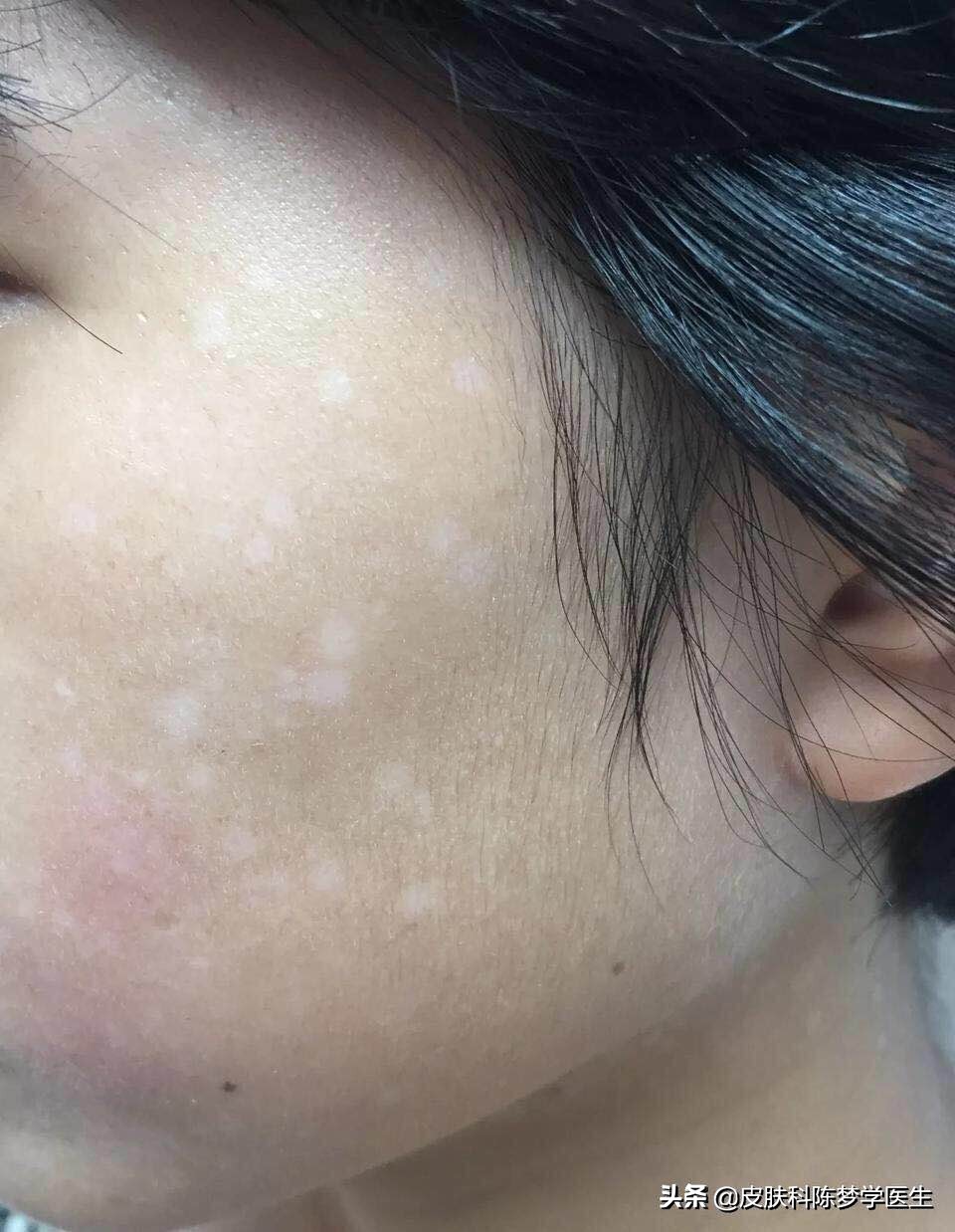 皮肤出现白斑吃什么好,皮肤发现白斑怎么办