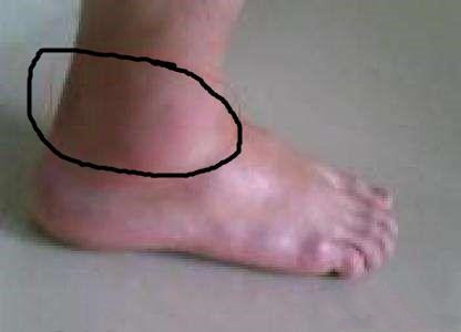 小李的脚受伤,小李崴脚