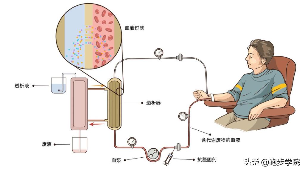 18岁运动时漏尿是怎么回事,运动不当引起茶色尿后自愈