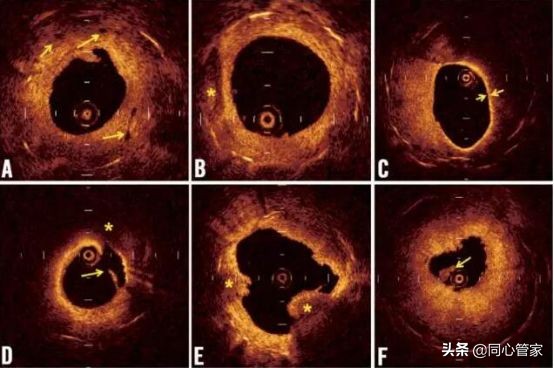 斑块和血栓ct区别,斑块和血栓的超声鉴别