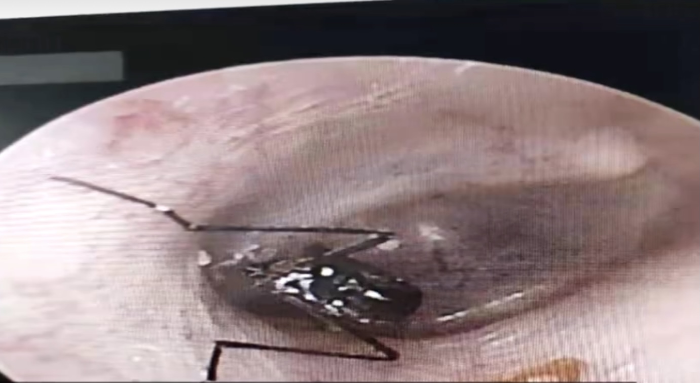 8岁男童在家睡觉耳朵钻进活蟑螂,男童睡觉耳朵钻进活蟑螂全过程