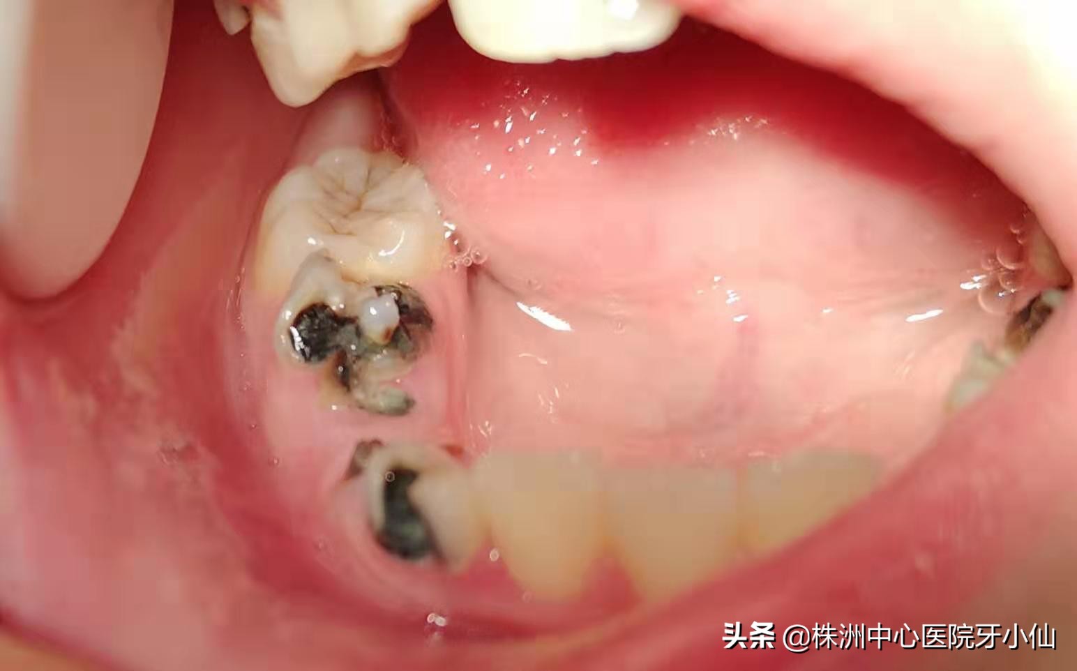 小孩哭闹对全麻手术有影响吗,看牙儿童哭闹怎么办