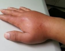 抓蜜蜂不小心被蜜蜂蛰,被蜜蜂蛰的第一时间