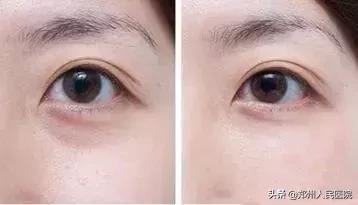 别急！注射玻尿酸之前，先弄清楚这几件事儿