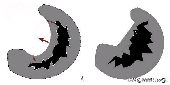 膝关节半月板损伤的磁共振,膝关节半月板病变的mri诊断与鉴别
