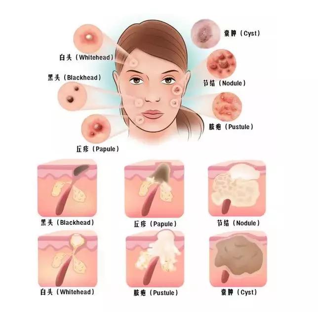 说说都如何治好痘痘的,一痘毁所有5个祛痘小技巧