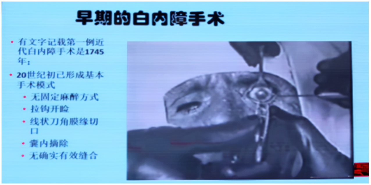 白内障手术技术历程,专家讲解白内障手术的重难点