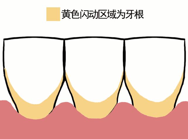 牙龈萎缩导致牙齿松动怎么办,牙龈萎缩很严重牙齿松动怎么办