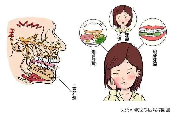 三叉神经痛牙疼症状为什么不消失,牙疼拔了后还疼是三叉神经疼吗