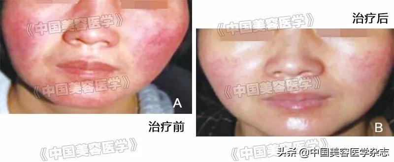 医用愈肤生物膜可以用于创伤吗,愈肤生物膜对唇炎有用吗