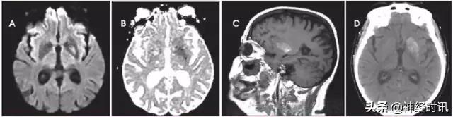 脑卒中的快速识别ppt,脑卒中神经影像学实例解析
