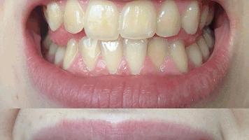 每秒振动1.5万次以下,一分钟震动10万次的牙刷