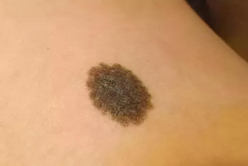 路边摆摊点痣用什么点痣,路边点痣和正规医院点痣区别