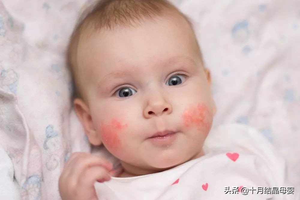 宝妈注意了，宝宝这些症状很可能是食物过敏
