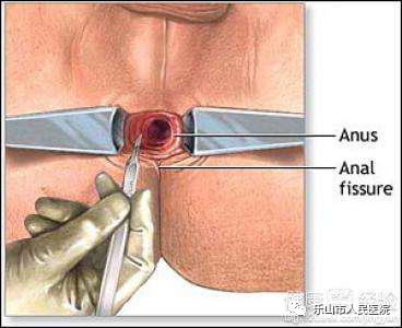 周期性疼痛肛裂,女便血肛裂便秘怎么用药