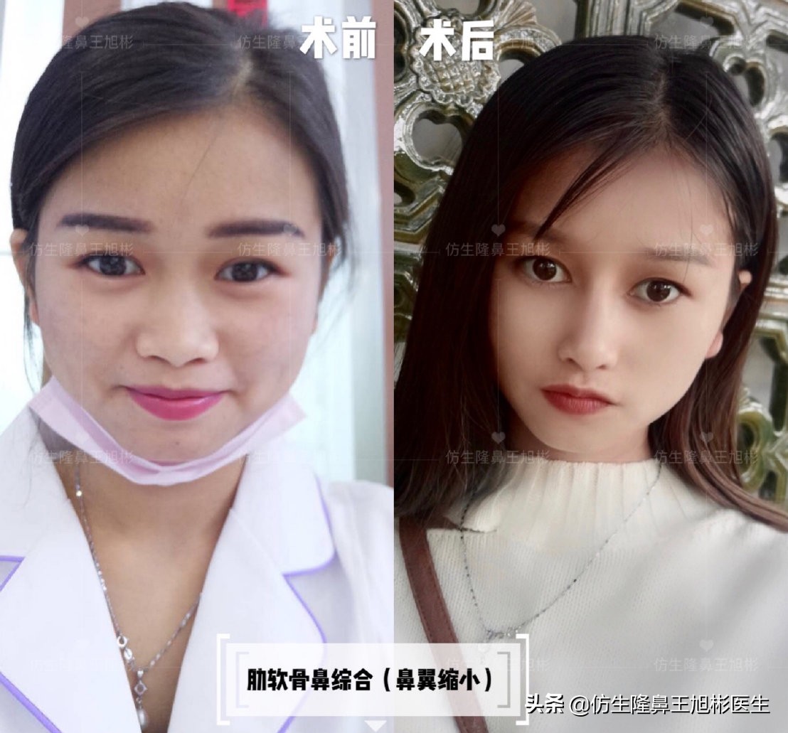 鼻头部位整形,鼻头圆钝高鼻梁整形案例