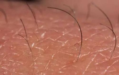 40天宝宝出现“猪毛风”，细心宝妈拔掉黑刺，反被医生怒斥太无知