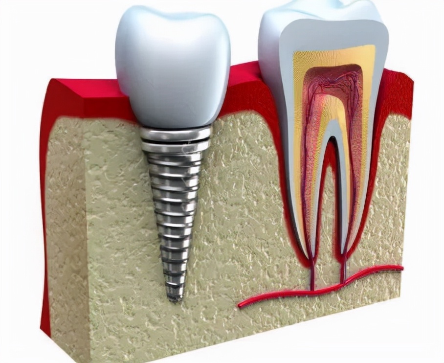 最好的种植牙材料成本价多少钱,种牙价格悬殊