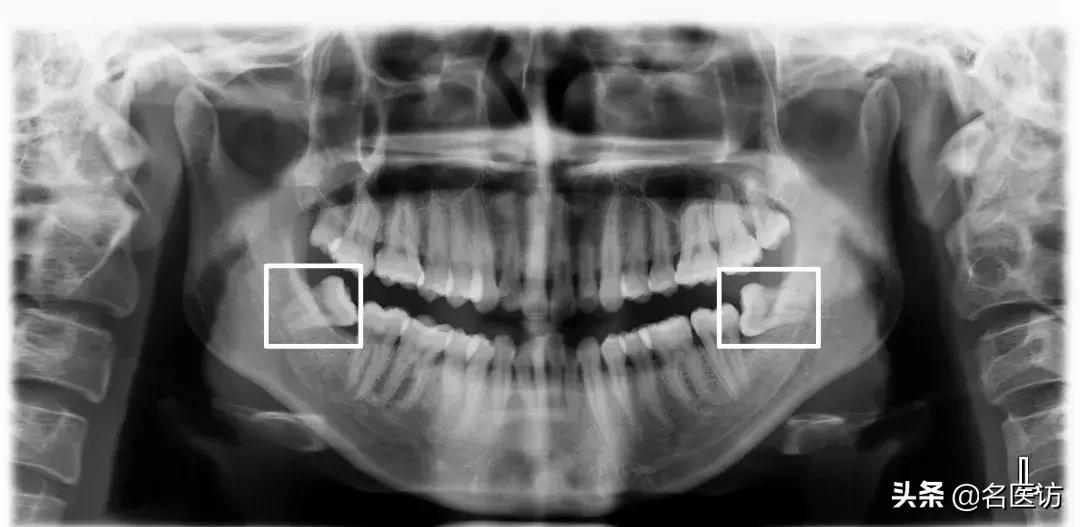 矫正科普|美人在骨不在皮，从神秘的牙片看牙齿和侧貌颜值