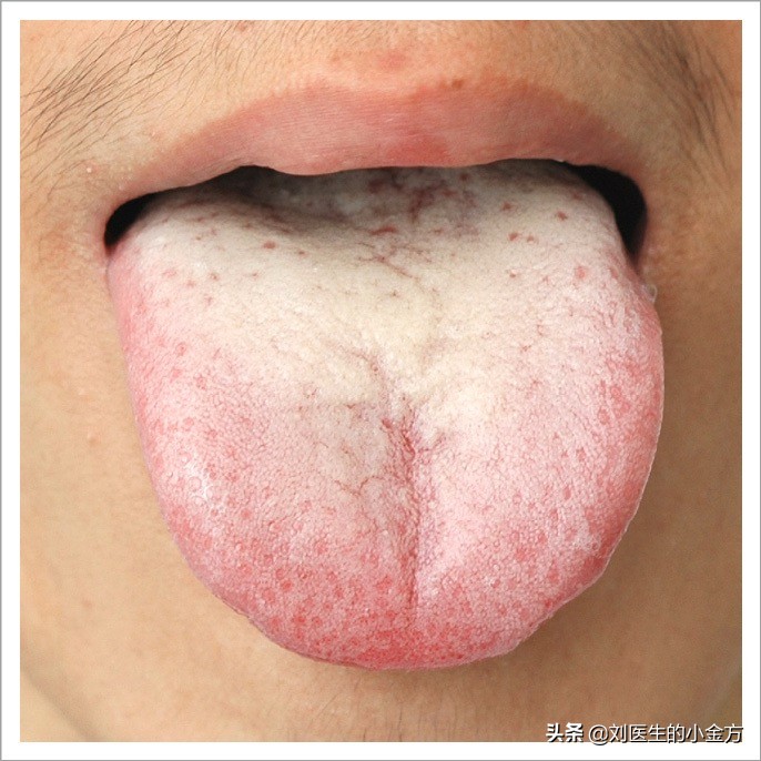 舌象图解大全中医舌诊,最全中医舌诊图谱来了