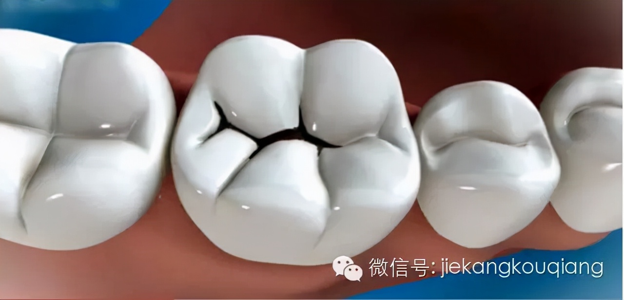 牙医一般都用什么材料补牙洞,牙医补牙全过程