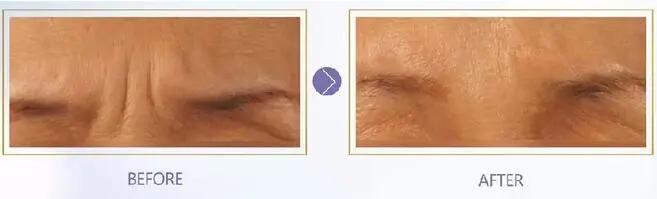 科普眉间纹,说说心里的那些事