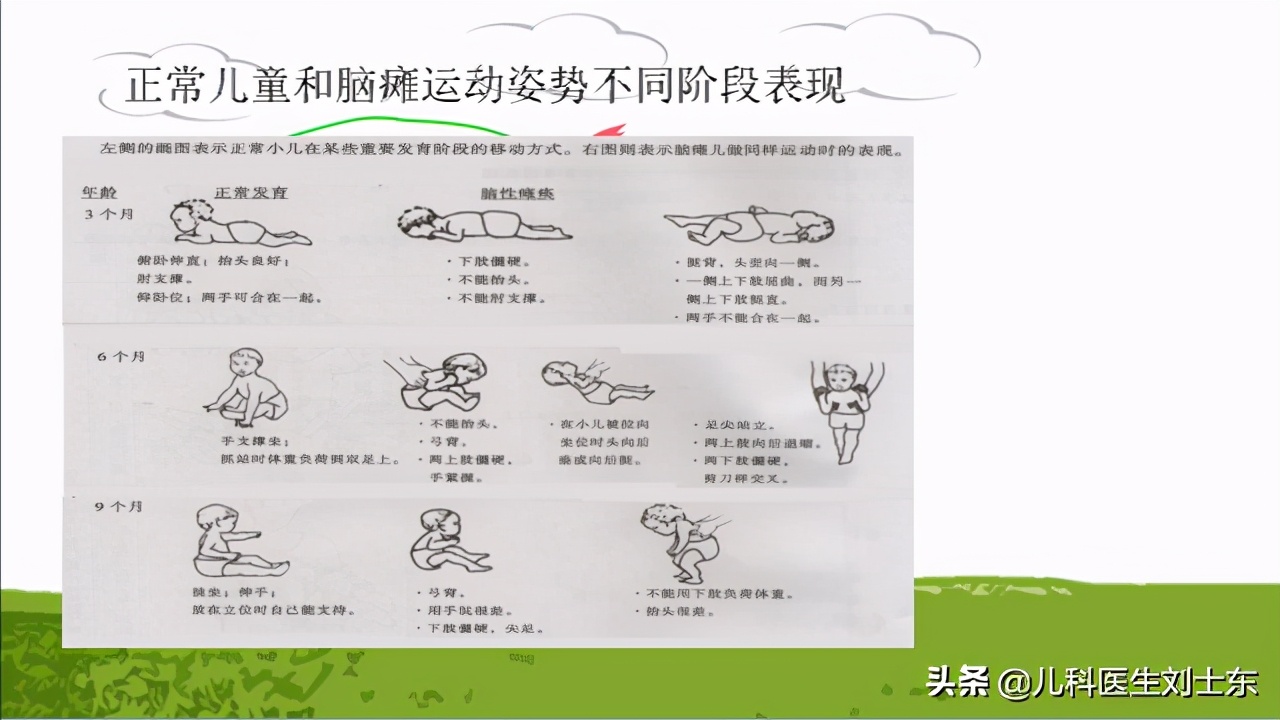 肉毒素治疗脑瘫患儿成功案例,肉毒素治疗脑瘫肌肉痉挛的效果