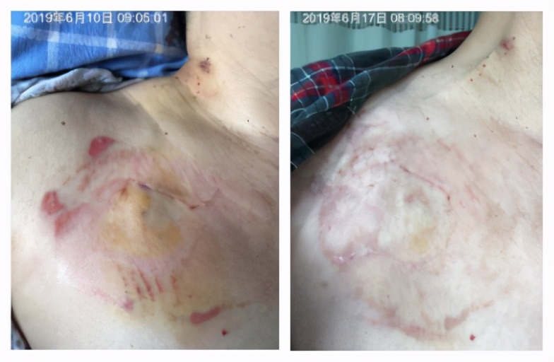 输液港皮肤过敏的处理,输液港输液有肿胀怎么处理