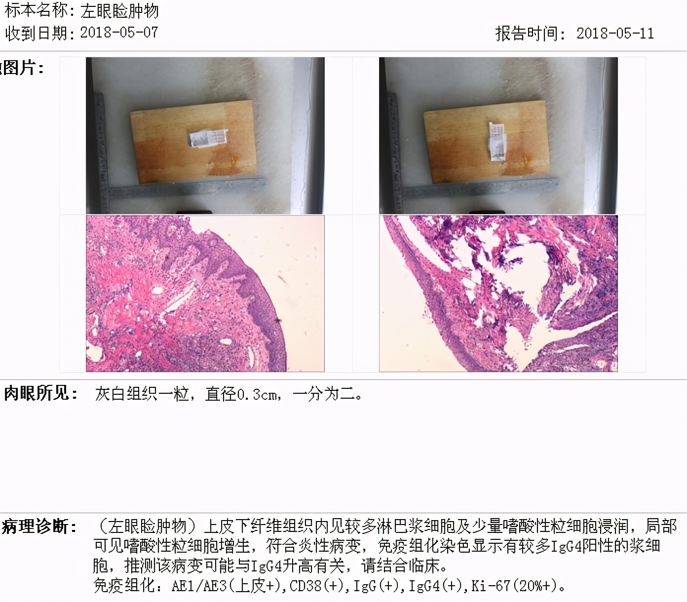 感冒哮喘用药不缓解,吃感冒药诱发哮喘