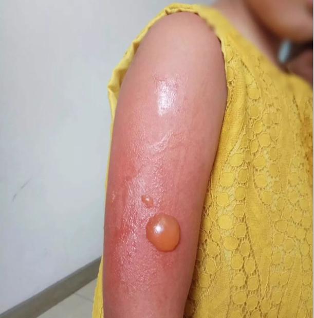 宝宝三岁前晒伤,别等孩子晒黑晒伤才开始涂防晒