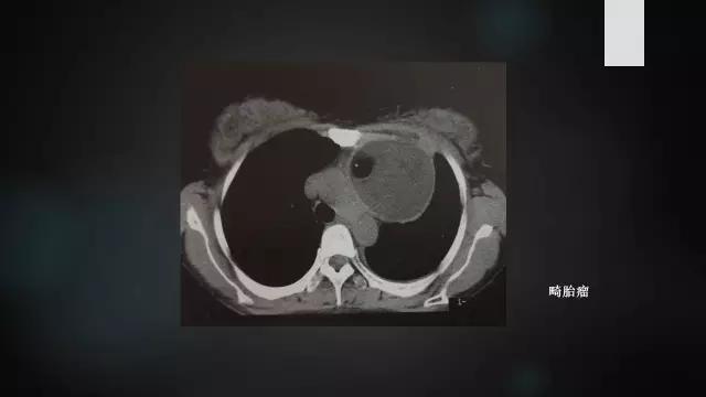 前上纵隔高密度影考虑胸腺未退化,肺纵隔胸腺结节12mm看什么科