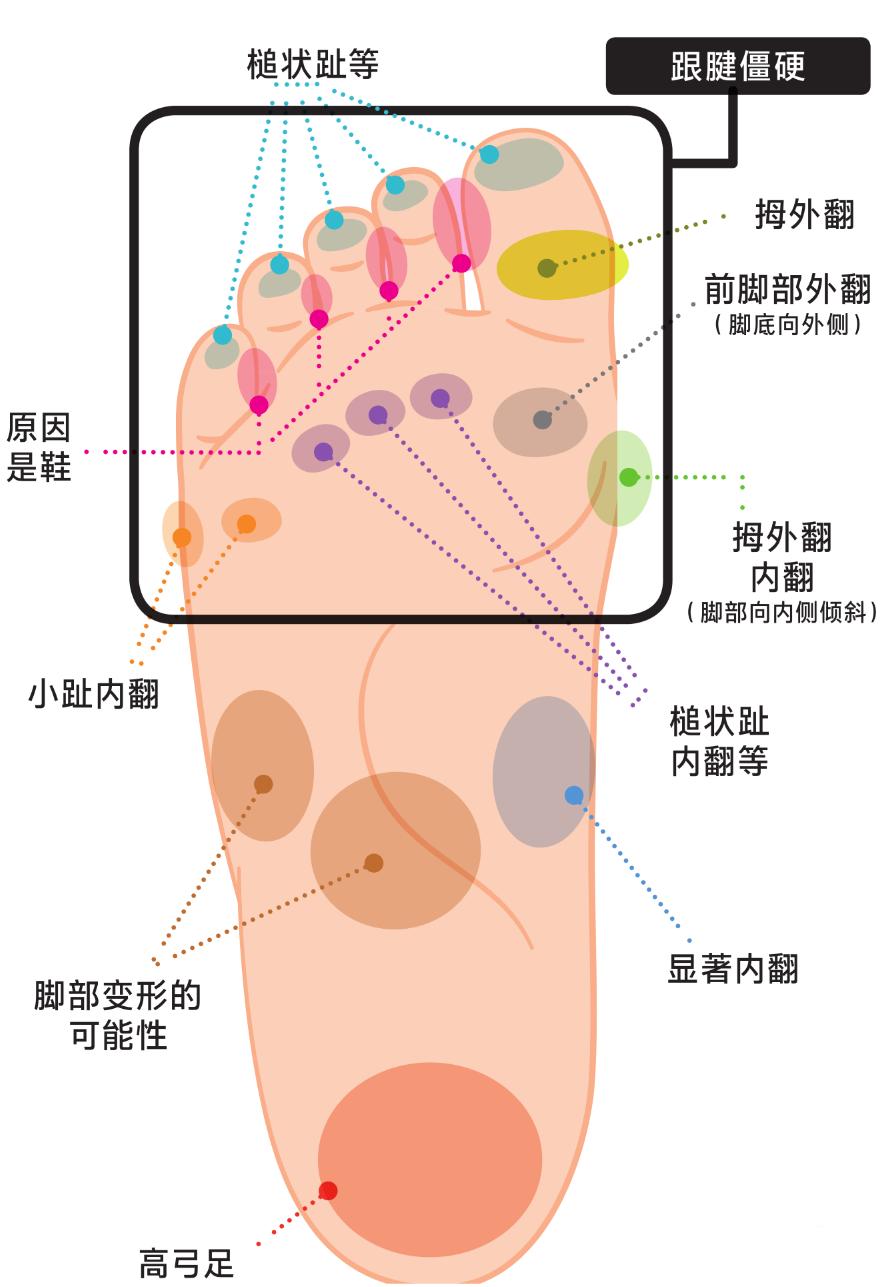 硬邦邦的老茧，会痛的鸡眼，日本皮肤科专家教你矫正足部恶习