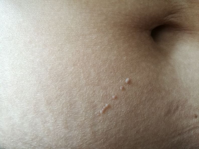 长成圆圈形状是癣还是湿疹,线状苔藓是什么原因造成的