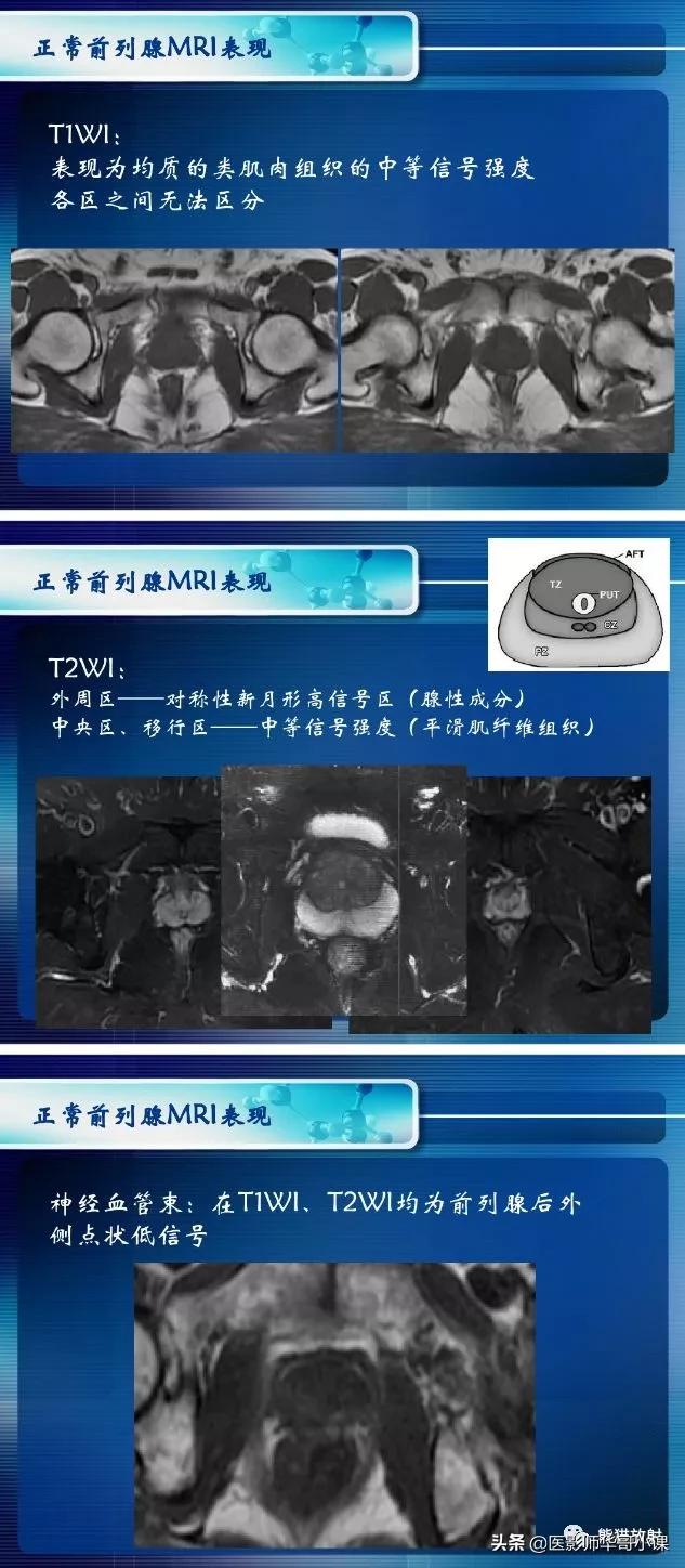 前列腺磁共振影像解剖,前列腺mri正常诊断报告模板