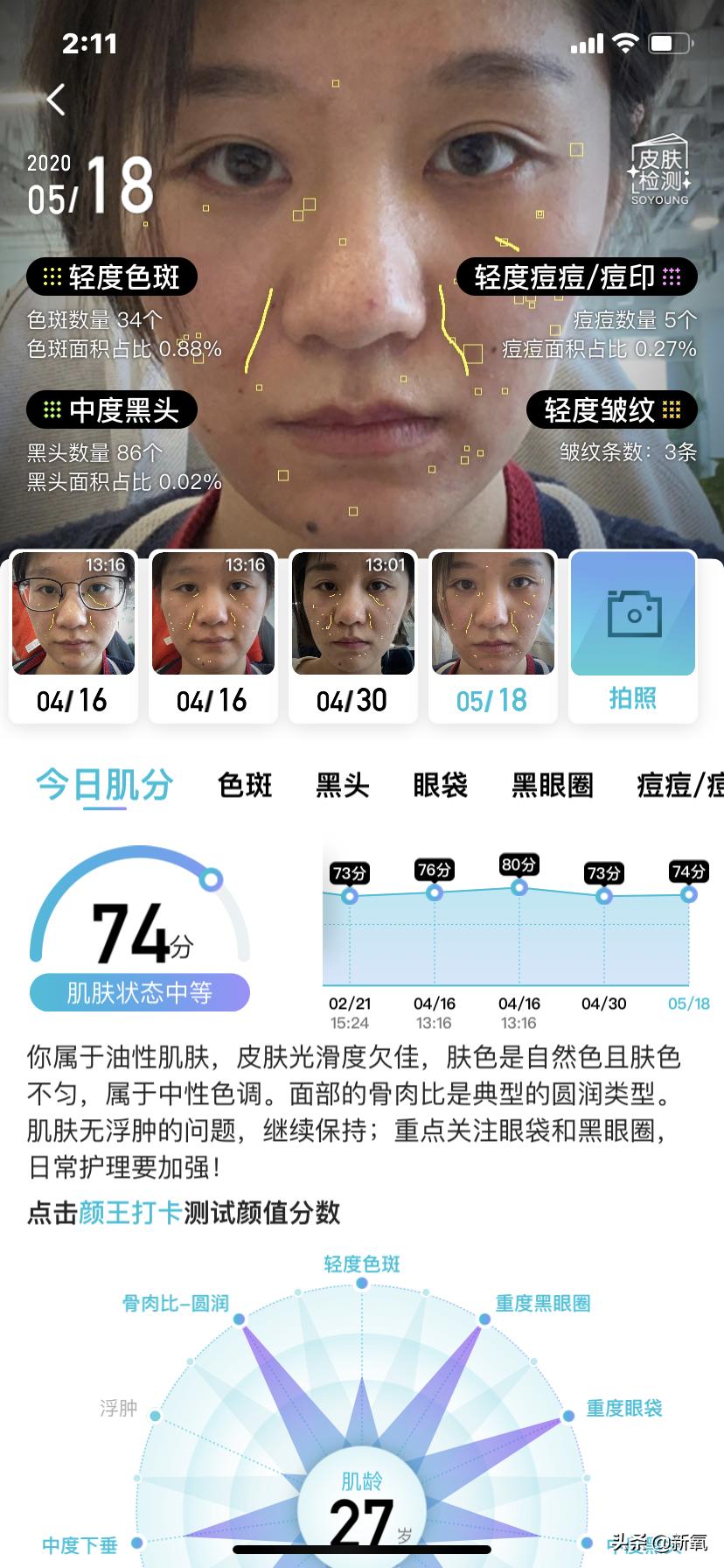 村姑整成鞠婧祎的鼻子变天使,鞠婧祎的鼻子整过吗