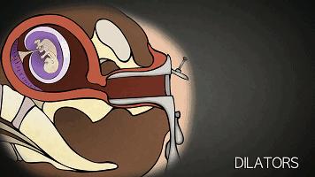 打胎有多可怕案例,20岁女生堕胎7次