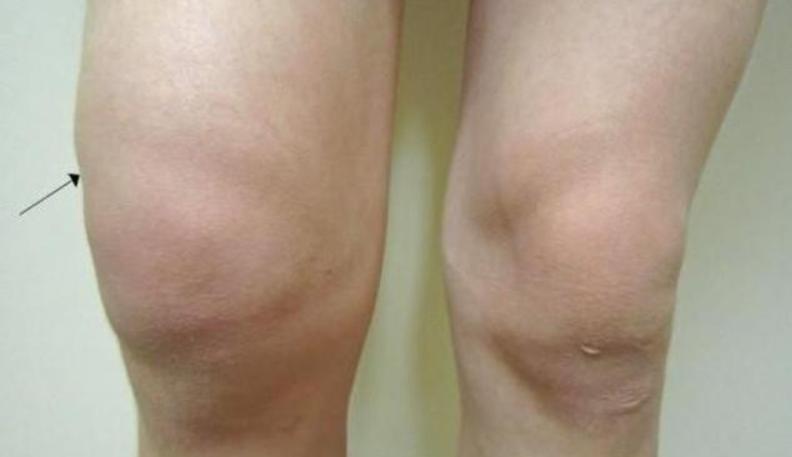 膝盖有滑膜炎，还能治愈吗？该怎么办？不想手术，3个要点需牢记