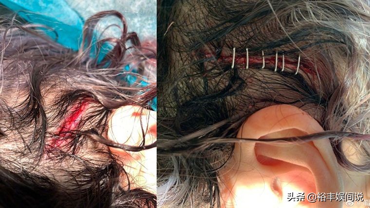 萧亚轩摔倒视频,萧亚轩受伤发言视频