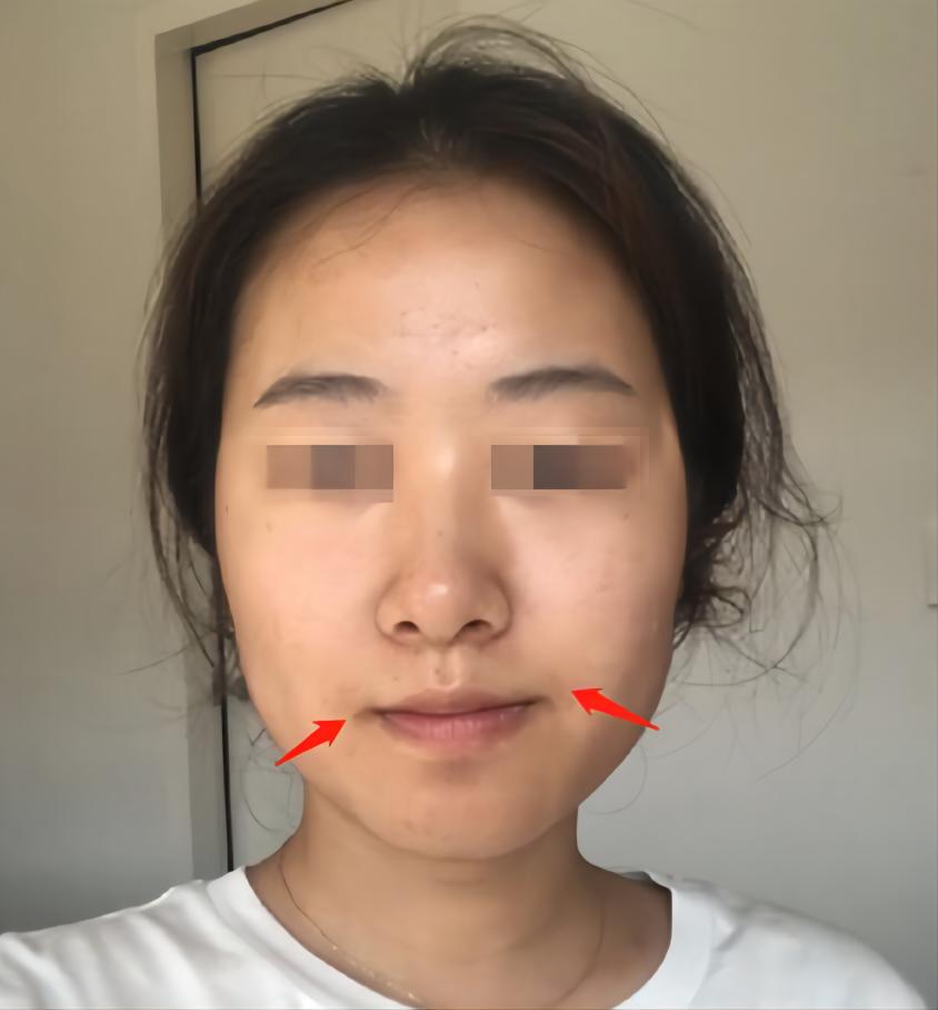 面部不对称的脸应该如何改善,左右脸不对称怎么改善