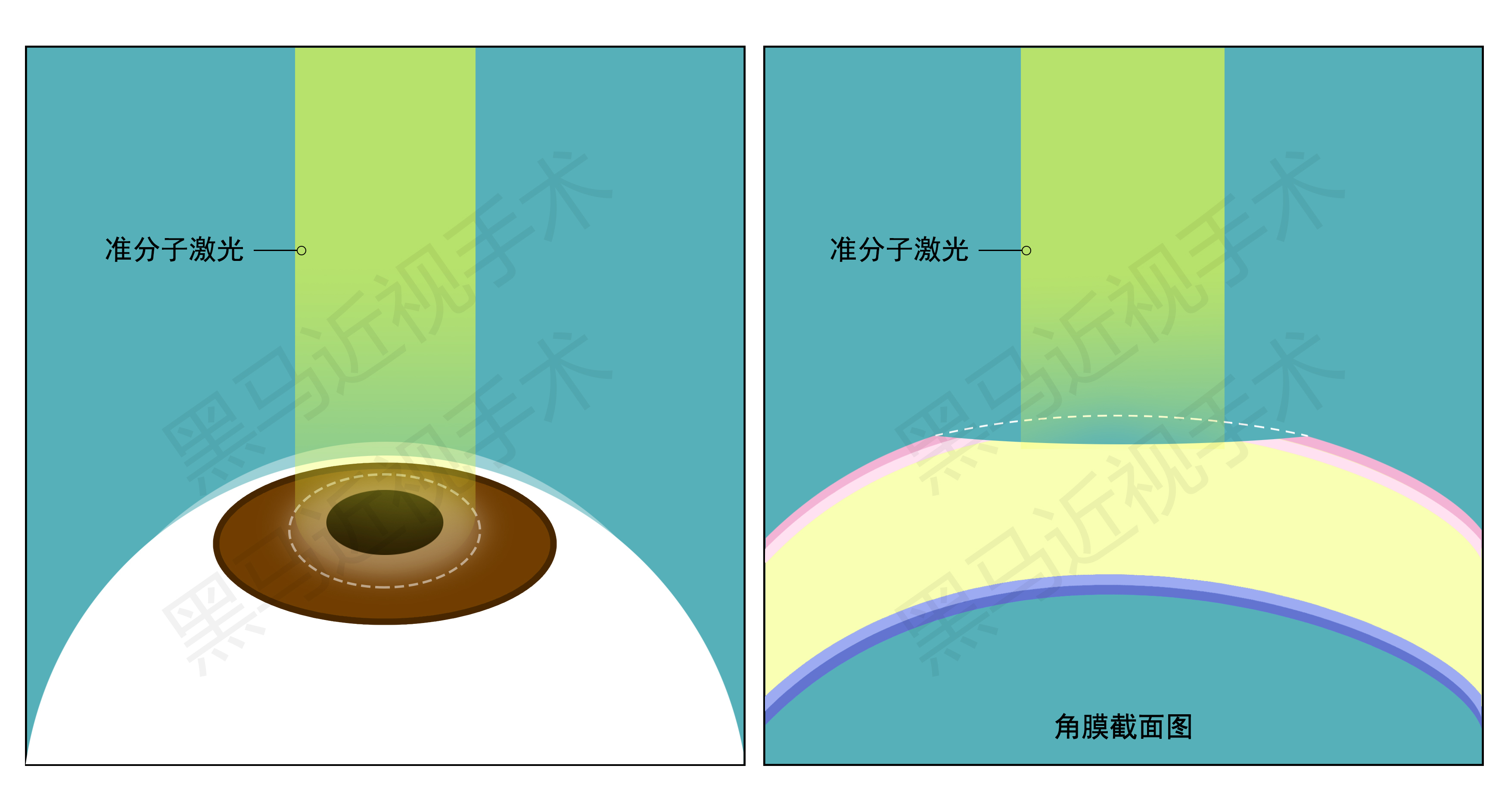近视300度做激光手术会有后遗症吗,激光近视手术的后遗症有哪些知乎