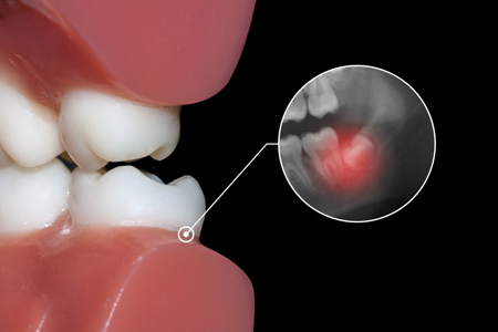 牙齿过敏导致的牙疼会疼几天,牙齿过敏怎么办快速止痛