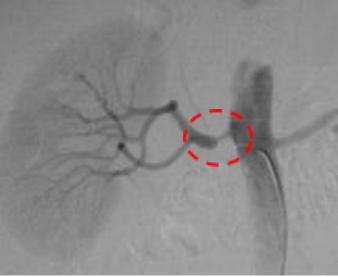 举例科普|介入能治疗哪些疾病?