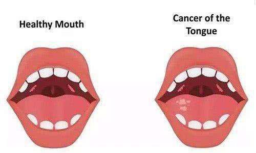 舌癌手术后怎么康复锻炼,舌癌患者术后语言康复训练