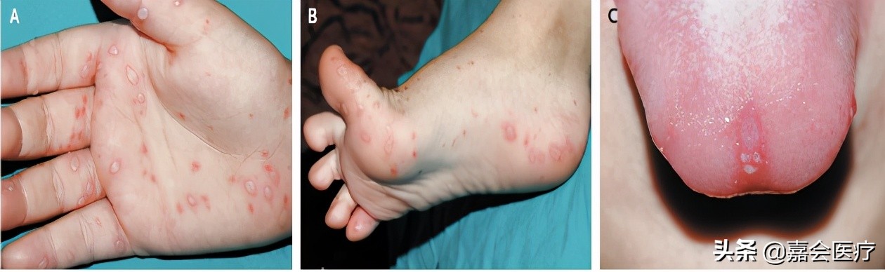 手足口病你必须知道,手足口病最新版知识解读