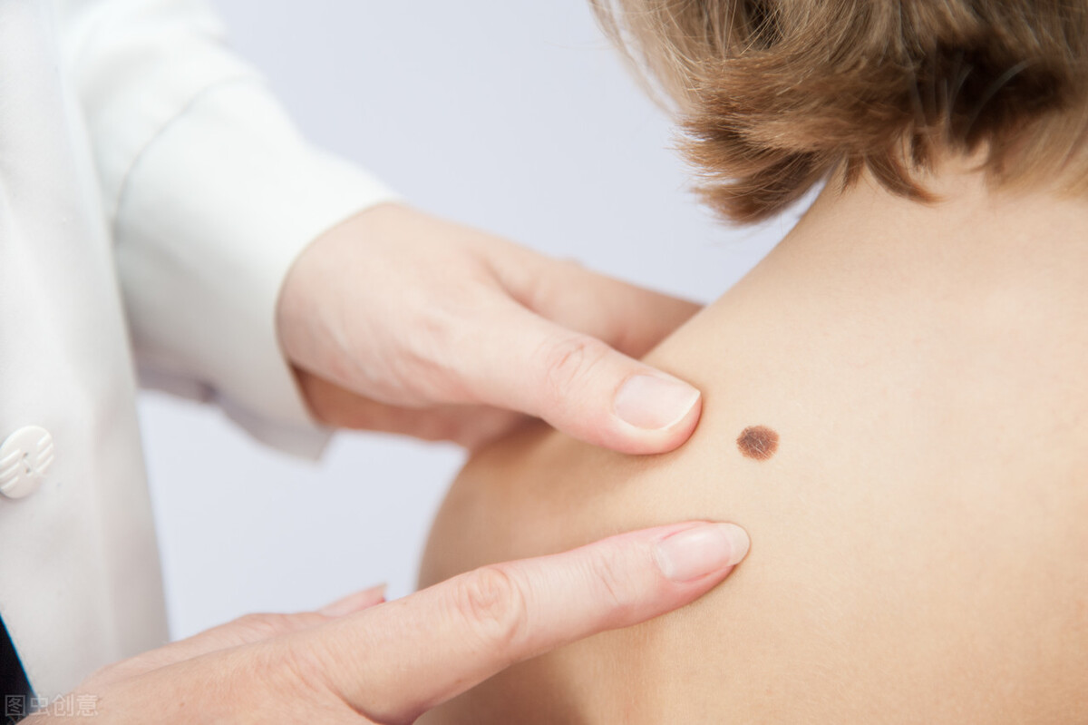 一般凸起的黑痣会癌变吗,长了20多年的黑痣有可能会癌变吗
