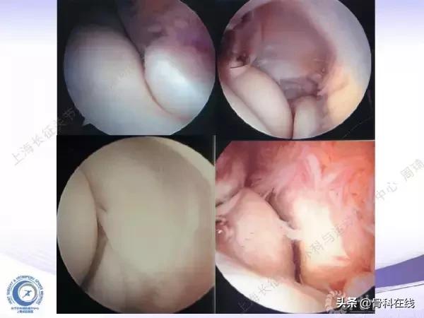 肘关节镜手术后引流,肘关节镜微创手术